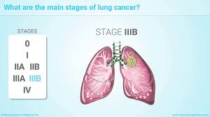 Staging Of Lung Cancer