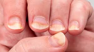 nail pitting what causes it how you