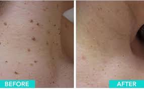 Skin Tag Removal From Just... - Serenity Beauty and Skin care | Facebook