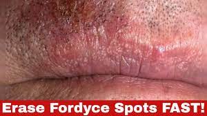 get rid of fordyce spots