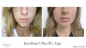 juvederm economics juvederm cost