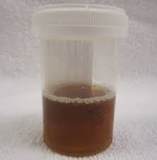 causes of dark or brown urine over a