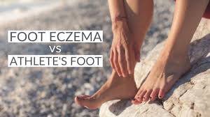 5 natural eczema on feet treatments