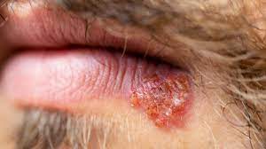 shingles vs herpes symptoms causes