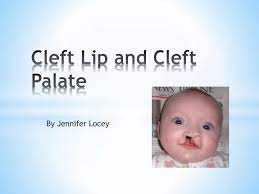 ppt cleft lip and cleft palate