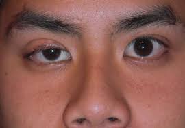 ptosis droopy eyelid surgery in