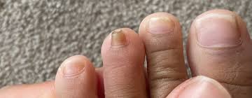 toddler thick yellow toe nails mumsnet