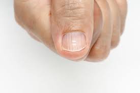 ridges in fingernails causes symptoms
