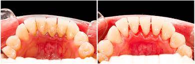 dental plaque and tartar causes