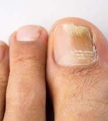 hydrogen peroxide for nail fungus