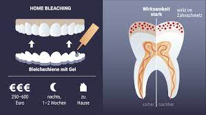 Der zahnarzt oder eine seiner mitarbeiterinnen zeigen ihnen, wie sie das bleichmittel zu hause einfüllen und die trägerfolien auf. Zahn Bleaching Focus Arztsuche
