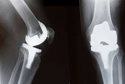 depuy knee replacement system failures