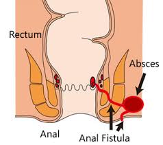 fistula treatment without surgery