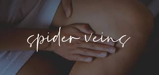spider vein treatment the vein centre