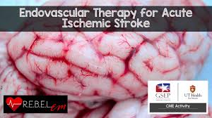 Cva6 became one of the major pathogens of hfmd in 2013 and 2015 in beijing. Endovascular Therapy For Acute Ischemic Stroke Rebel Em Emergency Medicine Blog