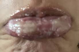 horrific lip burns