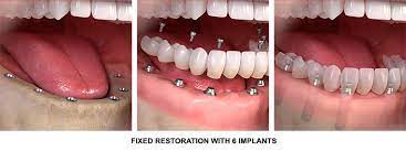 full mouth dental implants nyc all on