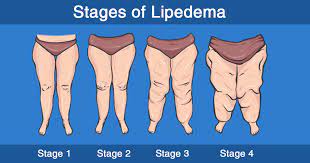lipedema when traditional obesity