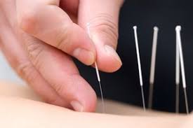 Image result for acupuncture pictures