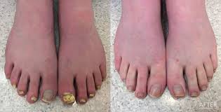 omaha dermatology toenail fungus