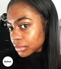 skincare routine for dark spots