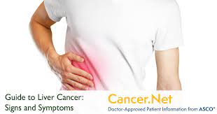 4 warning signs of liver cancer to watch out for. Liver Cancer Symptoms And Signs Cancer Net