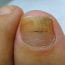 fungal nail infections sole body soul