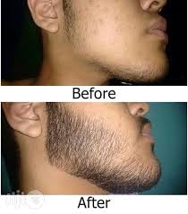 5 things i wish i knew before i started. Kirkland Minoxidil 5 Extra Strength Hair Regrowth For Men In Jabi Hair Beauty Naija Mall Ig Fb Jiji Ng