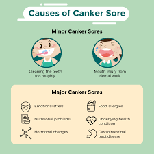 overview of canker sore swiperx