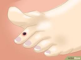 how to pop a blood blister 11 steps