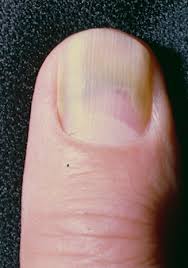green nail syndrome gns pseudomonas