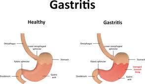 gastritis gastroenterologists in florida