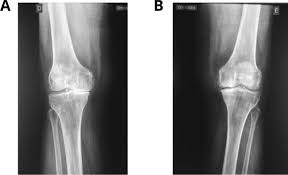 Ultrasonography findings in knee osteoarthritis: a prospective  observational cross-sectional study of 100 patients | Scientific Reports