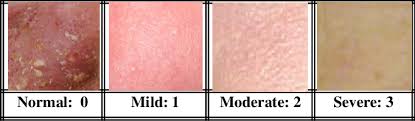 A Color Chart For The Severity Of Erythema Download