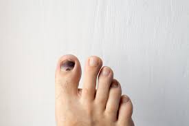 black spot on toenail should you be