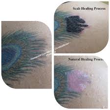 saline tattoo removal raleigh in nc