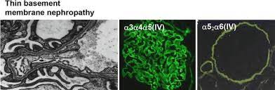 Thin Basement Membrane Nephropathy