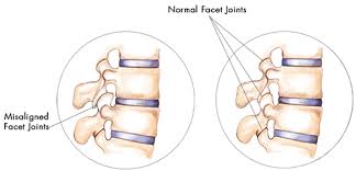 what causes facet syndrome and facet pain