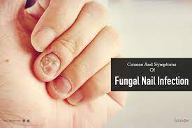 symptoms of fungal nail infection
