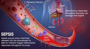 Learn about sepsis (blood infection) symptoms, risk factors, causes, treatment, survival rate, and causes of sepsis include pneumonia and urinary tract infection. Sepsis Top Neuro Docs