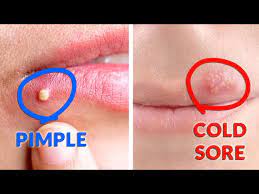 cold sore and pimple
