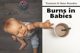 burns in es treatment and home