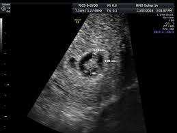 Diagnostic Ultrasound In The First Trimester Of Pregnancy