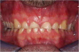 restorative treatment of tooth wear
