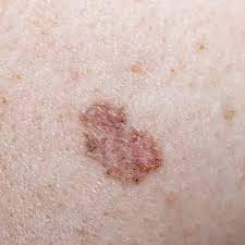 By knowing what your skin normally looks like, and how to spot the various types of skin cancer, you'll be able to alert if yours has changed or suddenly starts bleeding or itching, it's time to see your doctor. 6 Kinds Of Skin Cancer And Their Symptoms