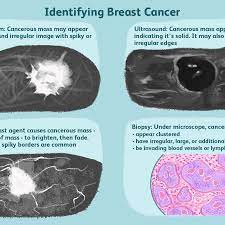 You may be prioritised if: Breast Masses Cancerous Tumor Or Benign Lump