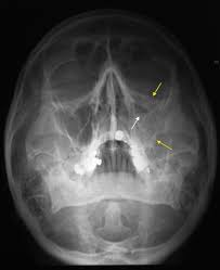 tripod fracture radiology at st