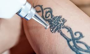 laser tattoo removal st helens st