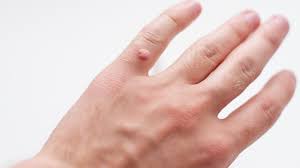 wart treatment and removal toronto
