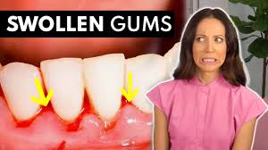 what swollen gums are telling you